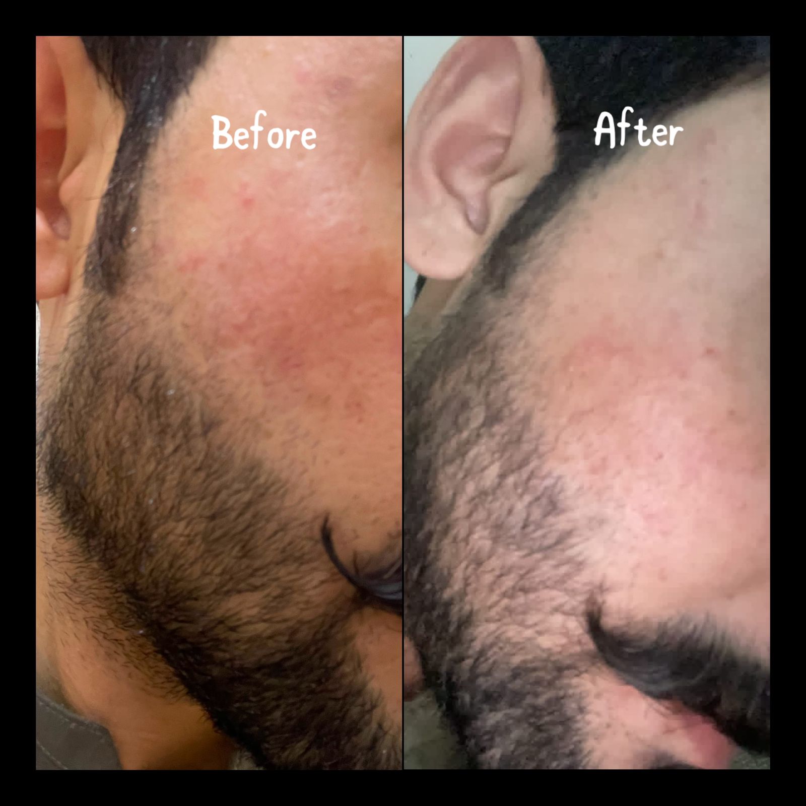 Eczema