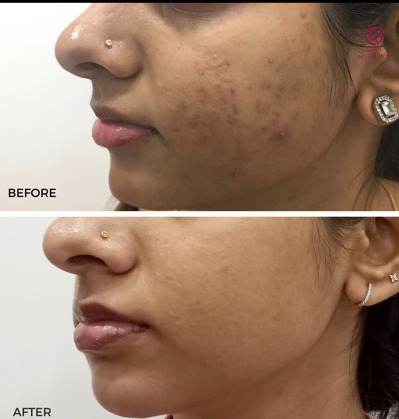 Acne Therapy