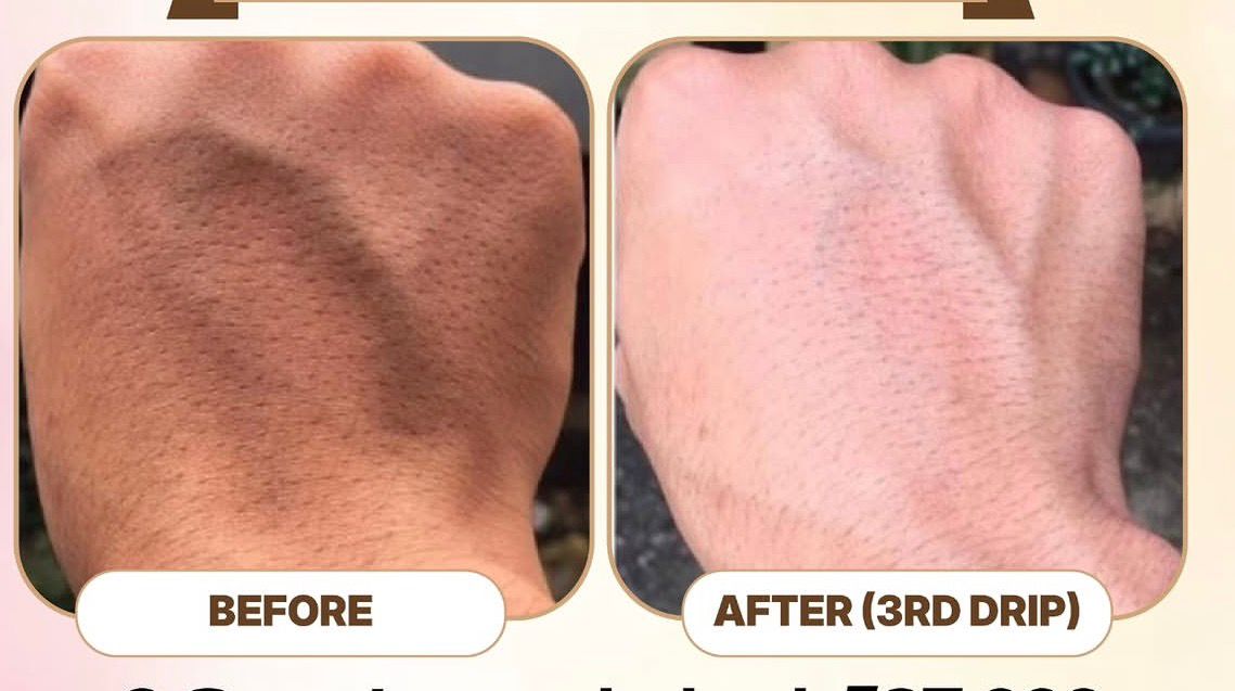 Collagen Drips