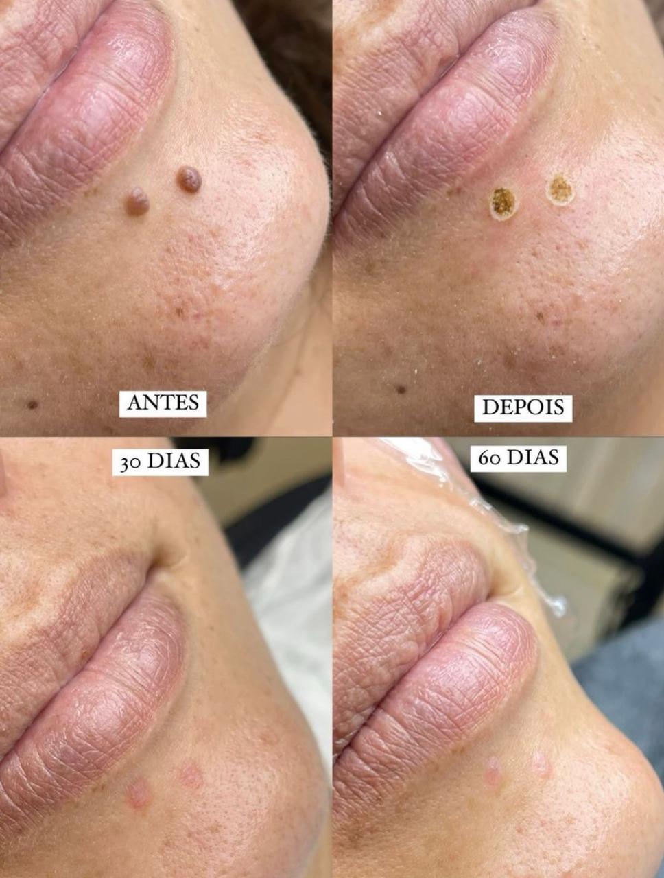 Mole Removal