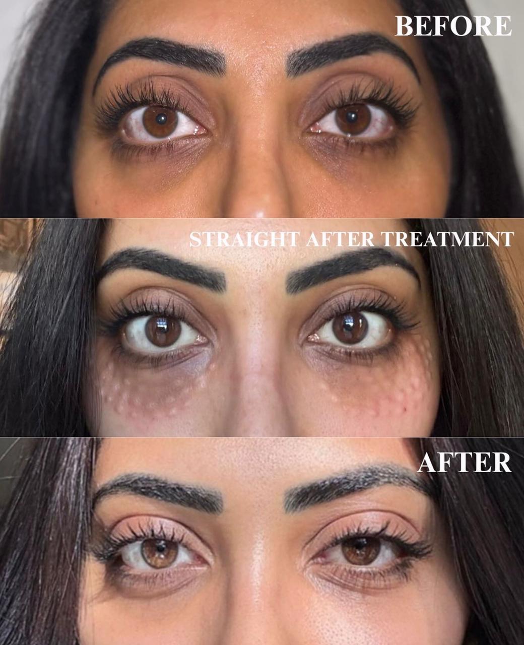 Dark Circles Treatment