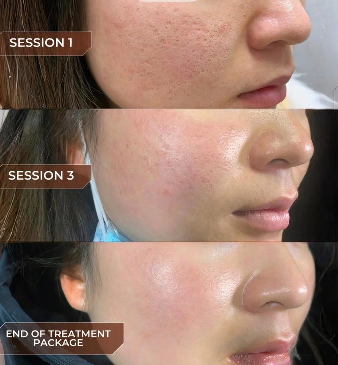 Acne Therapy