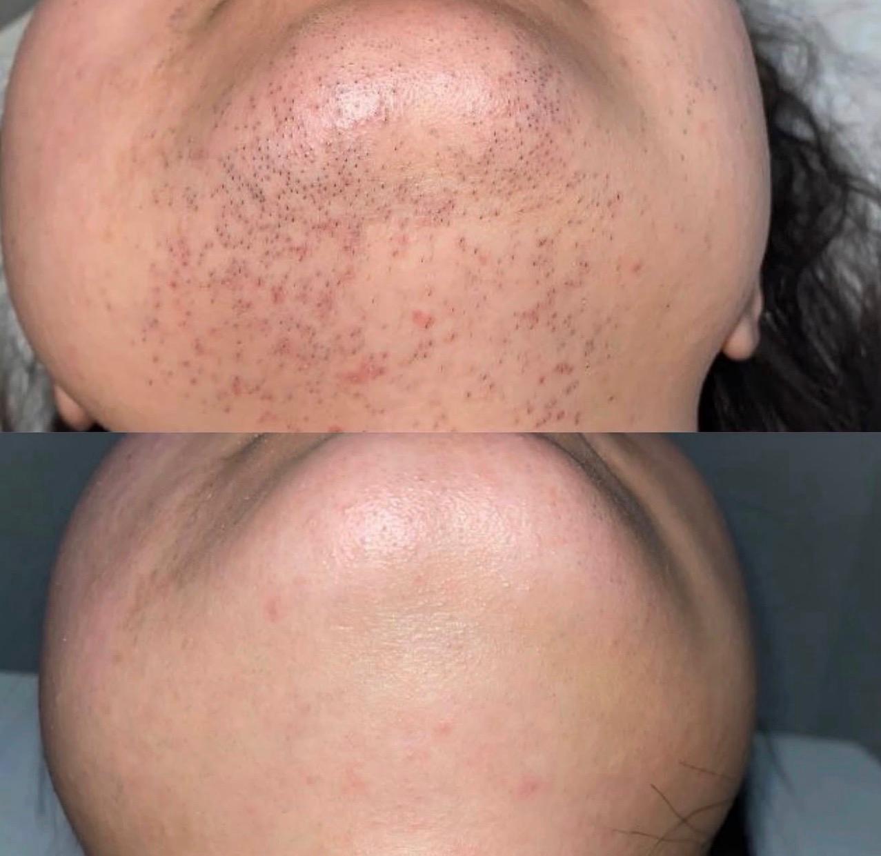 Laser Hair Removal