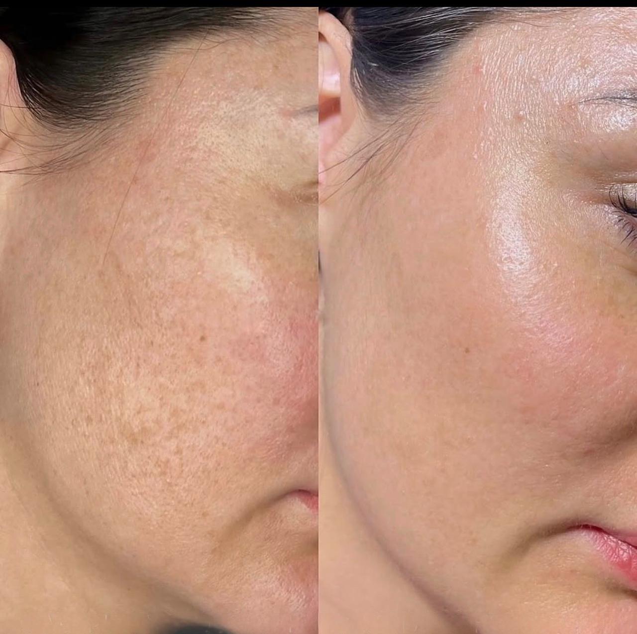 Sunspot Treatment