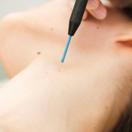 Electro Cautery