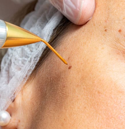 Mole Removal