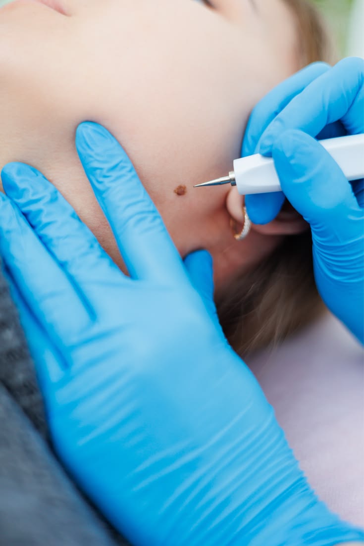 Warts Removing